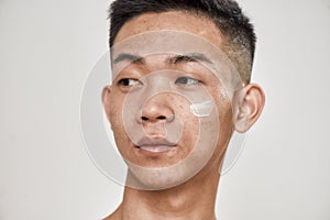 Close up portrait of young asian man with problematic skin applied cream on his face, looking aside isolated over white