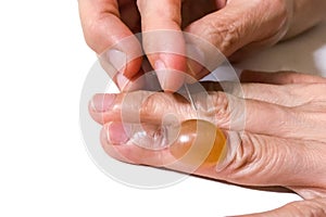 Close-up pricking painful inflammed fluid blister finger with sh