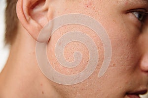 Acne scars on the face