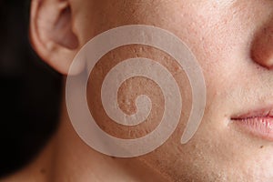 Acne scars on the face