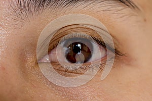 close up of the pterygium during eye examination. photo