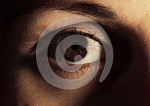 Close-up of a pterygium or surfer`s eye growing onto the cornea eye photo
