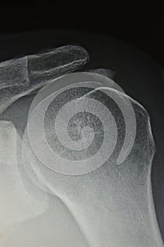 Close-up of radiography of painfull shoulder, calc