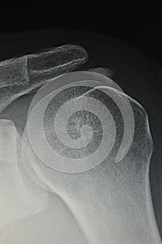 Close-up of radiography of painfull shoulder, calc photo