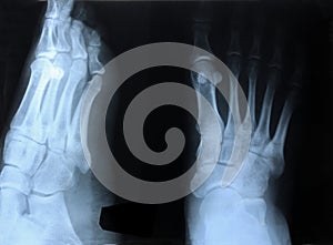 Close-up x-ray of the foot. condition of bones, joints and soft tissues