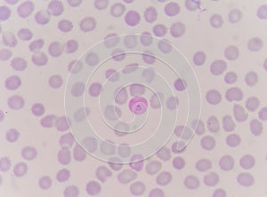 Close up red blood cells malaria pigment.