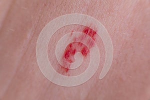 Close up of red hemangioma on pale skin