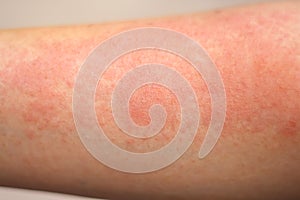 Close up red rash on asian woman arm., skin background