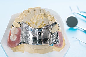 Removable partial denture RPD.