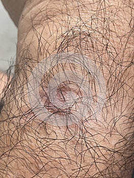 close up scar on human body