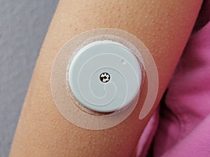 Close up of sensor on hand for device for continuously glucose monitoring in  blood Ã¢â¬â CGM.. Insulin depend. Diabetes type 1 photo