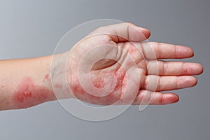 Shingles, Zoster or Herpes Zoster symptoms on arm photo