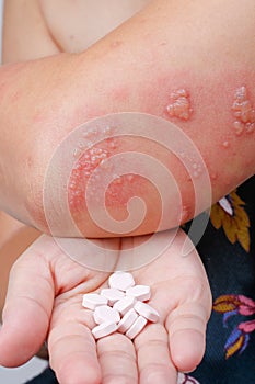 Shingles, Zoster or Herpes Zoster symptoms with antiviral drug photo