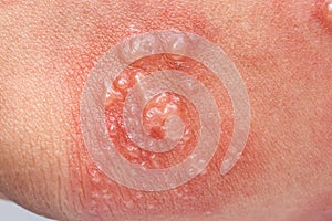 Shingles, Zoster or Herpes Zoster symptoms on arm photo