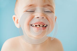 Close up shot of baby teeth with caries
