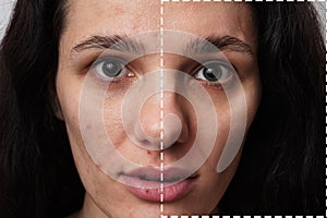 A close-up shot of the face of a young woman with skin problems - pimples, acne, enlarged pores. with and without filter