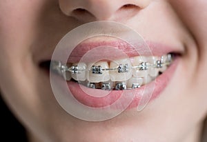 Close-up shot of teeth with braces. Female patient with metal brackets at the dental office. Orthodontic Treatment