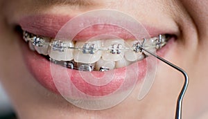 Close-up shot of teeth with braces. Female patient with metal brackets at the dental office. Orthodontic Treatment.
