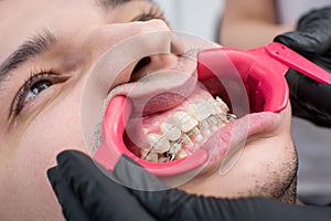 Close-up shot of white teeth with braces and dental retractor at the dental office