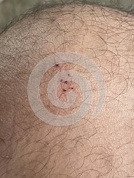 close up shot of a wound on his knee
