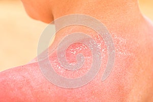 A close up shoulder with red sun burnt skin