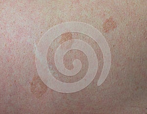 Close up skin disease Tinea versicolor/Pityriasis versicolor