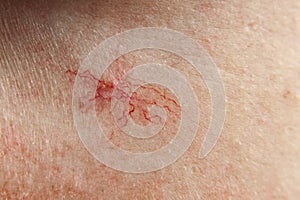 Close-up on the skin of the girl's face are visible couperose, red and dilated capillaries, spider veins, vascular photo