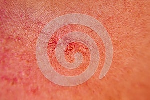 Close-up on the skin of the girl's face are visible couperose, red and dilated capillaries, spider veins, vascular photo