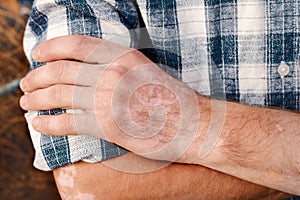 Close-up skin of a man`s hand with vitiligo symptoms