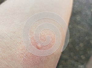 Close-up of skin with a mosquito bite and reddened skin