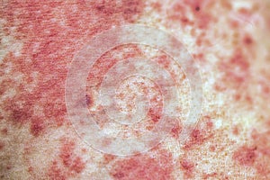 Allergic rash on the body close
