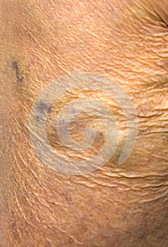 Close-up of skin with varicose veins