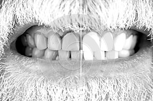 Close-up Of A Smiling man Teeth Before And After Whitening. Male teeth before and after whitening, oral care dentistry