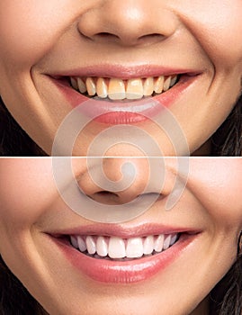 Close-up Of Smiling Woman Teeth Before And After Whitening