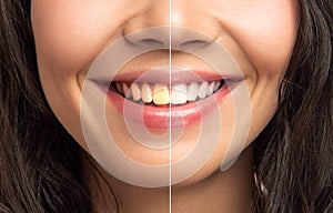 Close-up Of Smiling Woman Teeth Before And After Whitening