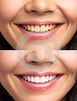 Close-up Of Smiling Woman Teeth Before And After Whitening photo