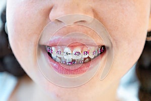 Close-up of smiling young girl with ligature brackets on white teeth. Concept of orthodontic, dentistry and malocclusion