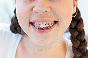 Close-up of smiling young woman with braces on white teeth. Concept of orthodontic, dental care and malocclusion