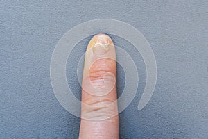 Close-up of a sore hand finger with a fungus on a gray background. Onycholysis: detachment of the nail from the nail bed