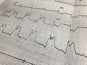 ST elevation on ECG paper photo