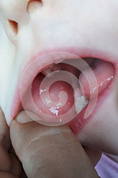 Close-up of stomatitis into mouth.Stomatitis viral genesis on the cheek of a child photo