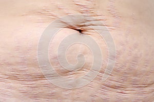 Close up stretch marks on belly