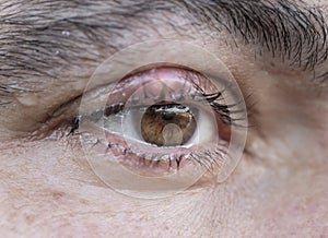 Close up, STYE, HORDEOLUM, CHALAZION, macro detail of an eye infection.