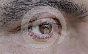 Close up, STYE, HORDEOLUM, CHALAZION, macro detail of an eye infection. photo