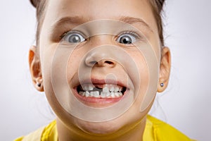 Close-up of super excited female kid with opened mouth showing missing front baby tooth and bulging eyes on white