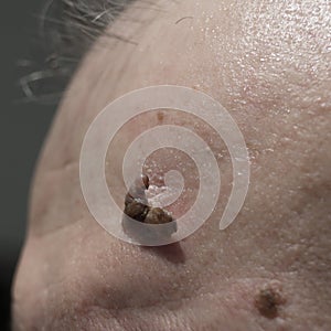 Close up of suspicious mole on skin