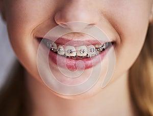 Close up of teeth with braces