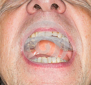 Close up of teeth guard in senior mouth