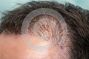 Close up top view of a man`s head with hair transplant surgery with a receding hair line