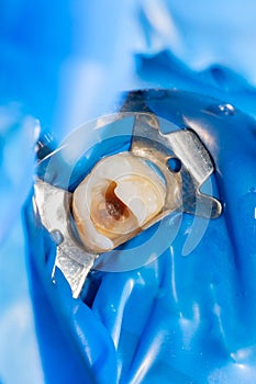 Close-up treatment of a human tooth using a blue rabberdam system and a dental mirror. Aesthetic dentistry, hygiene